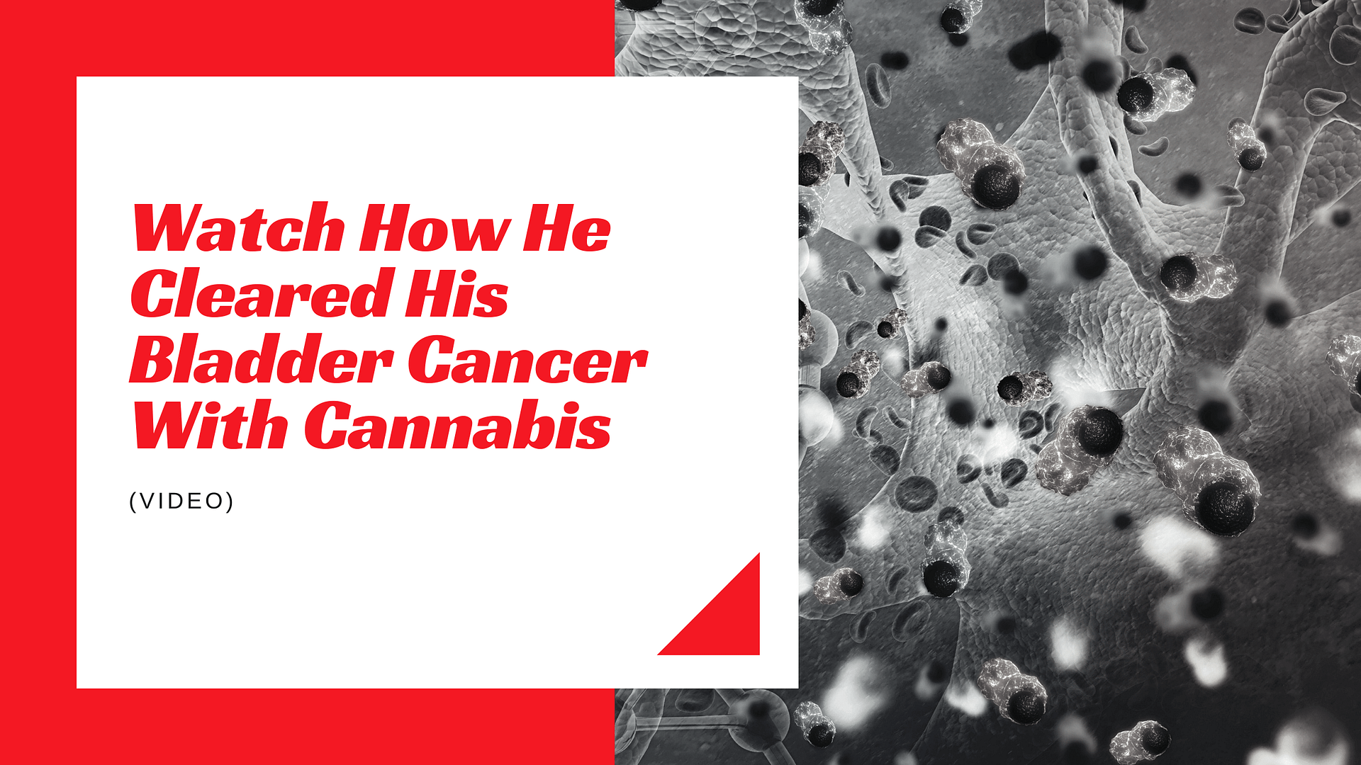 Watch How He Cleared His Bladder Cancer With Cannabis (Video)